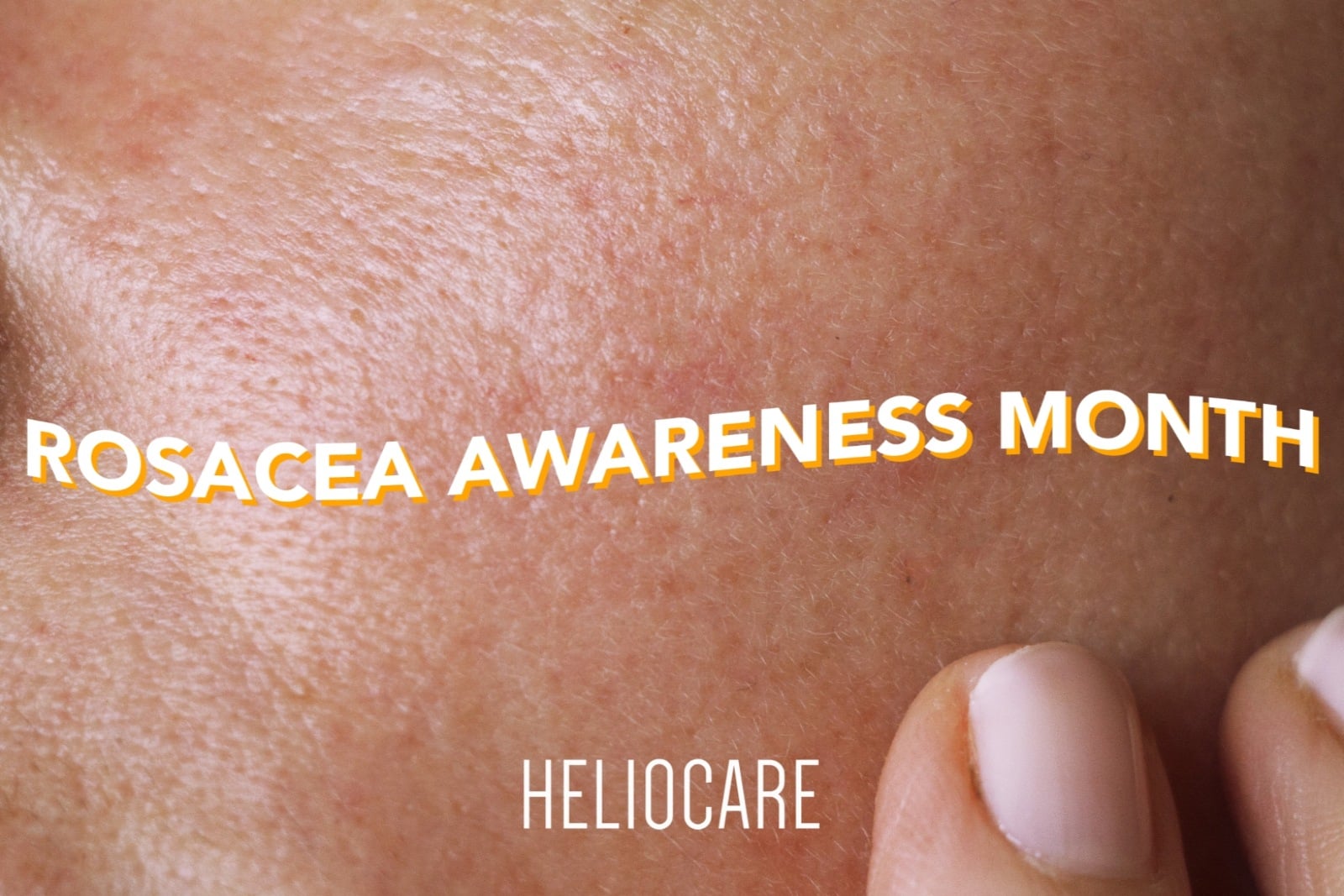 You are currently viewing CELEBRATE ROSACEA AWARENESS MONTH WITH HELIOCARE